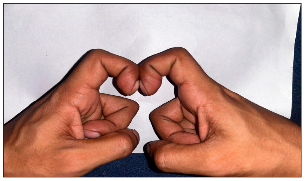 Schamroth sign elicited by placing the dorsal surfaces of terminal phalanges of corresponding right and left index fingers together.