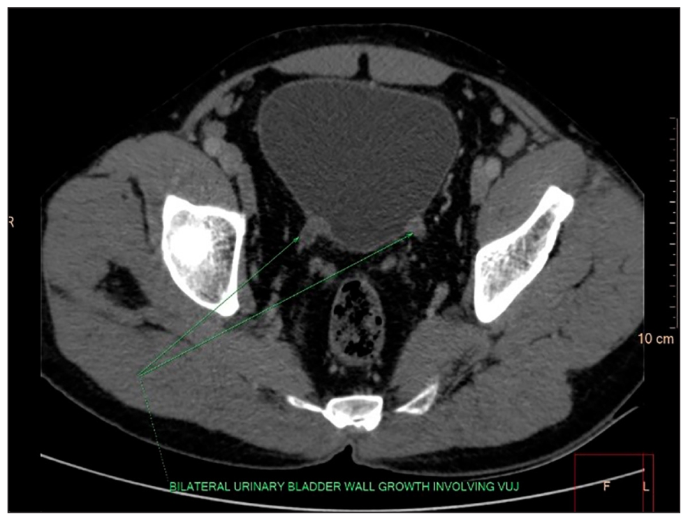 CT Urography (Post-contast HU:60) Heterogeneously enhancing endoluminal polypoidal wall thickening of the growth of the posteroinferior wall of the bladder with extension into bilateral Vesicoureteric junctions (VUJs). Mild surrounding fat stranding and neovascularisation are seen.