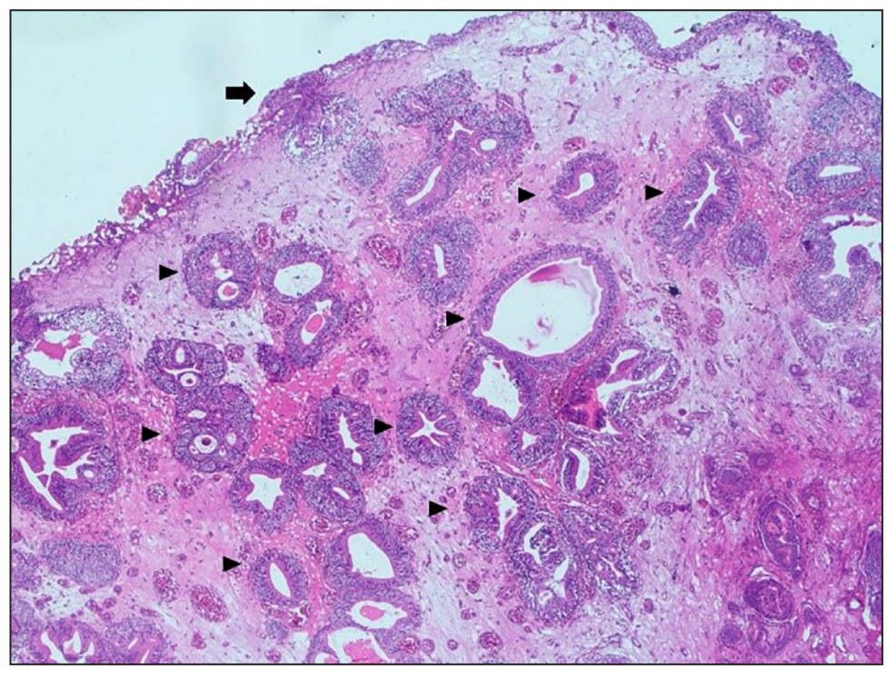 Haematoxylin and eosin stain (100× magnification) bladder mucosa partially lined by transitional epithelium (arrow) with underlying ingrowth of mucosa in the form of cystitis cystica represented by central space lined by transitional epithelium (arrowheads).