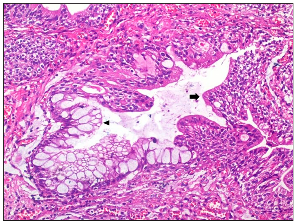 Haematoxylin and eosin stain (200× magnification) cystitis glandularis is represented by a central space showing partial metaplasia of transitional epithelium (arrow) by mucin-filled goblet cells (arrowhead).