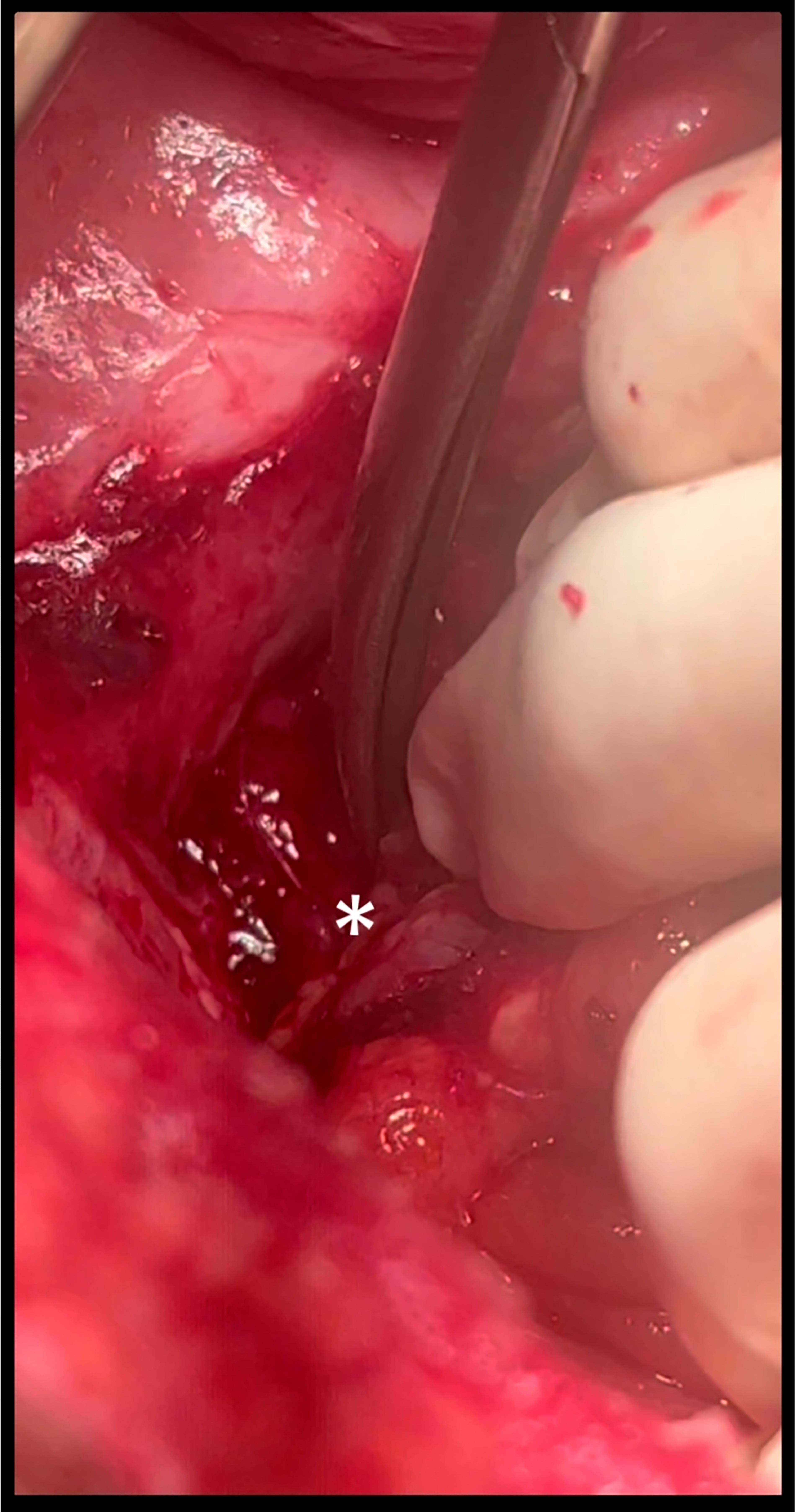 Asterisk shows anastomosis leak site with fistulous tract.