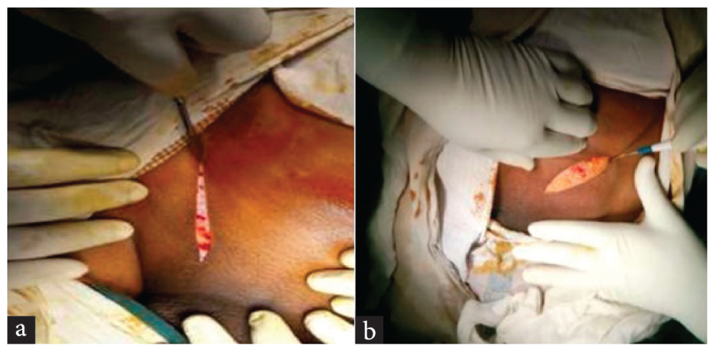 a) Operative incision with scalpel, b) Operative incision with diathermy.