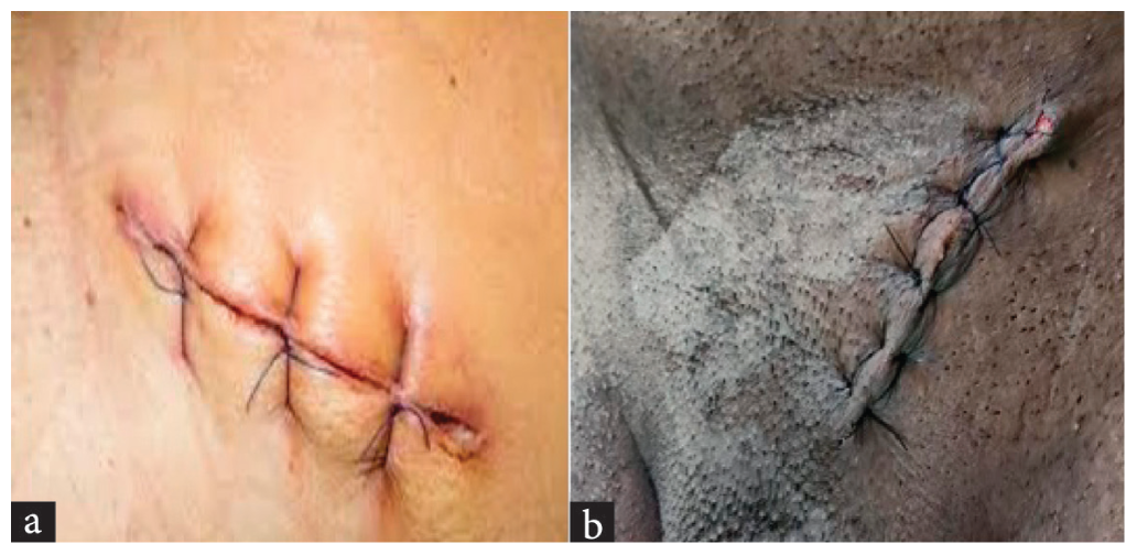 a) Postoperative image of scalpel, b) Postoperative image of diathermy.