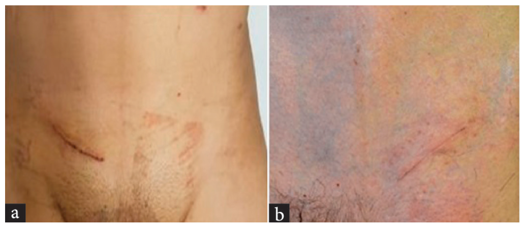 a) Healed incision after 1 month of Scalpel, b) Healed incision after 1 month of diathermy.